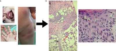 Case Report: Expanding Clinical, Immunological and Genetic Findings in Sideroblastic Anemia With Immunodeficiency, Fevers and Development Delay (SIFD) Syndrome